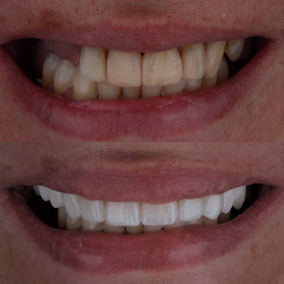 Caso 1 de reabilitação na Oral Unic Capão da Canoa: sorriso antes e depois do tratamento