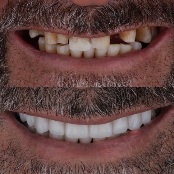 Caso 3 de reabilitação na Oral Unic Capão da Canoa: sorriso antes e depois do tratamento