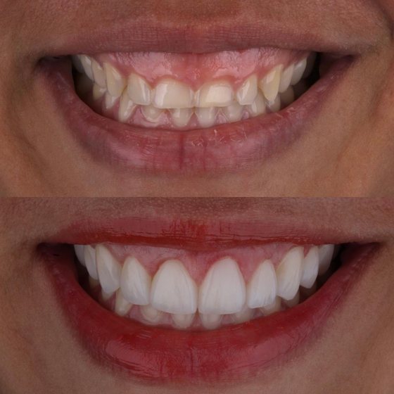 Caso 5 de reabilitação na Oral Unic Capão da Canoa: sorriso antes e depois do tratamento