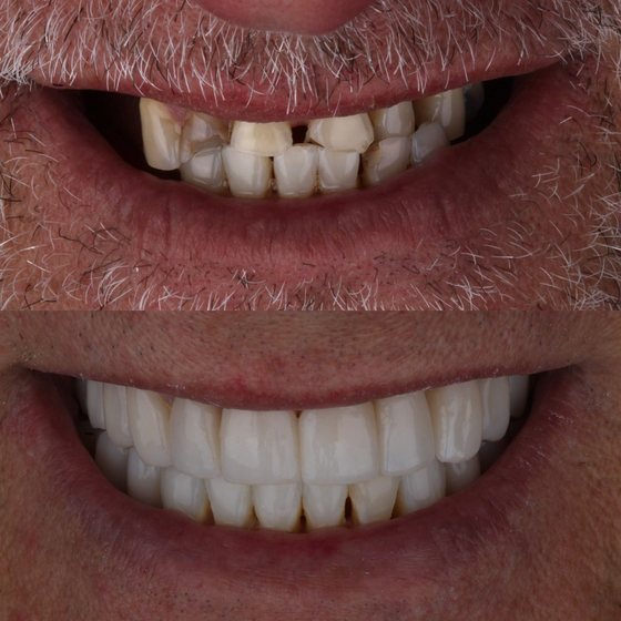 Caso 6 de reabilitação na Oral Unic Capão da Canoa: sorriso antes e depois do tratamento