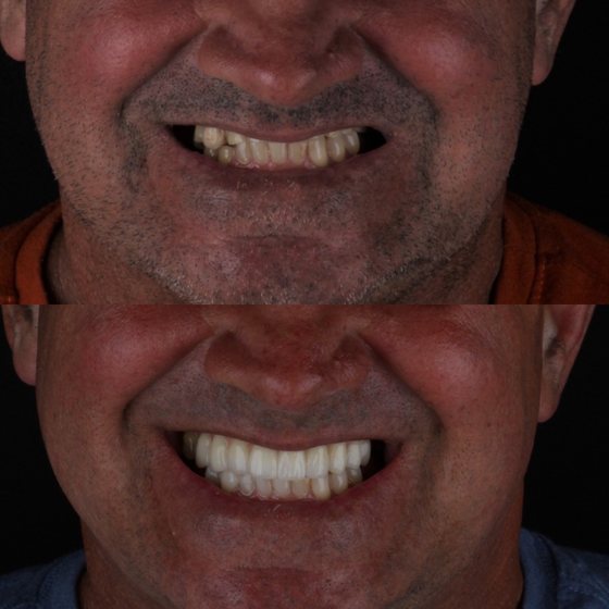 Caso 7 de reabilitação na Oral Unic Capão da Canoa: sorriso antes e depois do tratamento